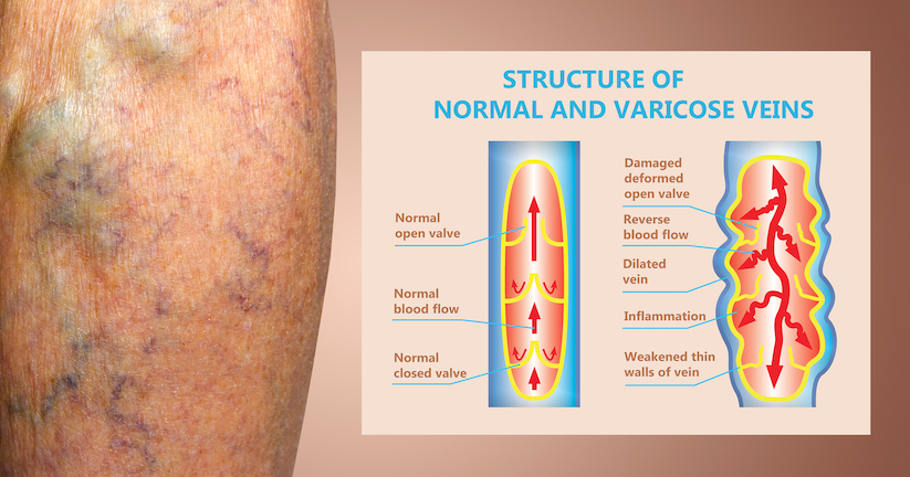 Varicose Veins Think You Know The Facts The Medical News Insider