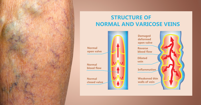 varicose-veins-think-you-know-the-facts-the-medical-news-insider